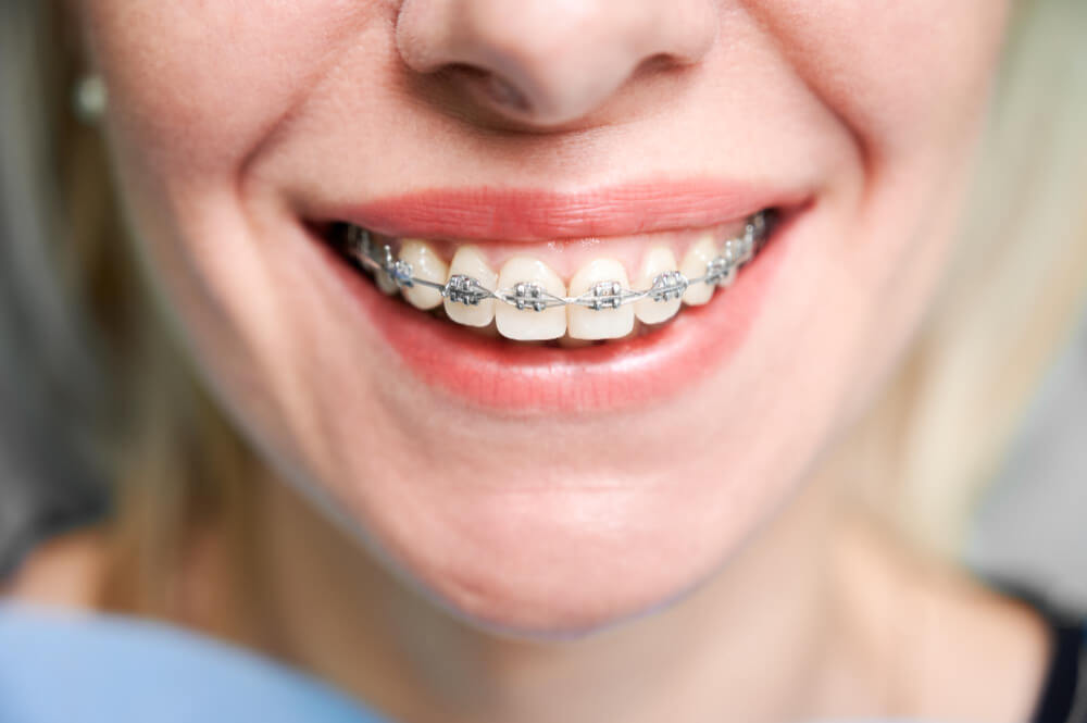 การจัดฟันแบบติดเครื่องมือ (Braces)
