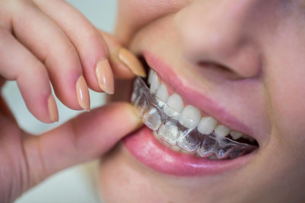 การจัดฟันแบบใส Clear Aligner